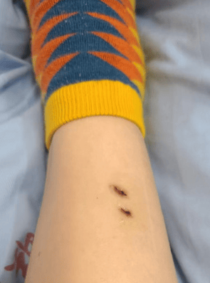 皇冠信用網会员开户
_女子在云南被银环蛇咬伤打了十多支血清皇冠信用網会员开户
,自称2年后仍有后遗症:头晕脸麻,没想到恢复得这么慢