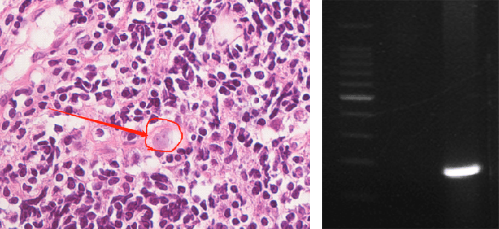 皇冠信用盘登2_上海确诊1例!张文宏团队参与会诊!病死率极高皇冠信用盘登2,发病一周内迅速恶化
