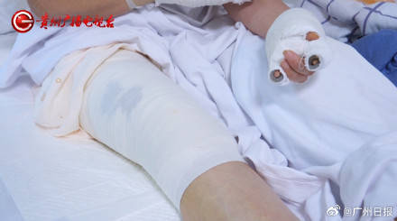 皇冠信用网注册
_女子水中捡漂亮石头装裤兜里被烧伤皇冠信用网注册
,医生:“石头”初步判定是磷