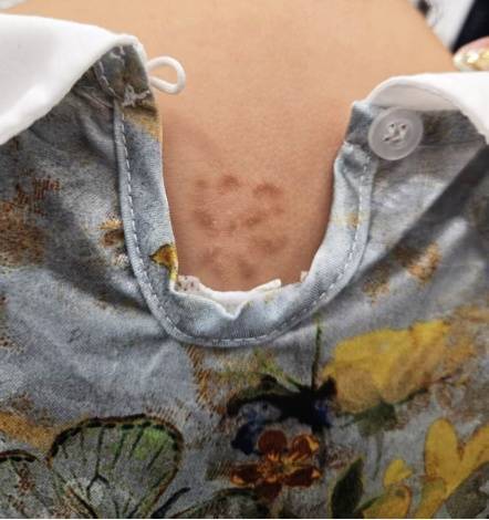 皇冠信用盘结算日是哪天_杭州5岁女孩背上惊现“梅花印”皇冠信用盘结算日是哪天,罪魁祸首竟是家里的……